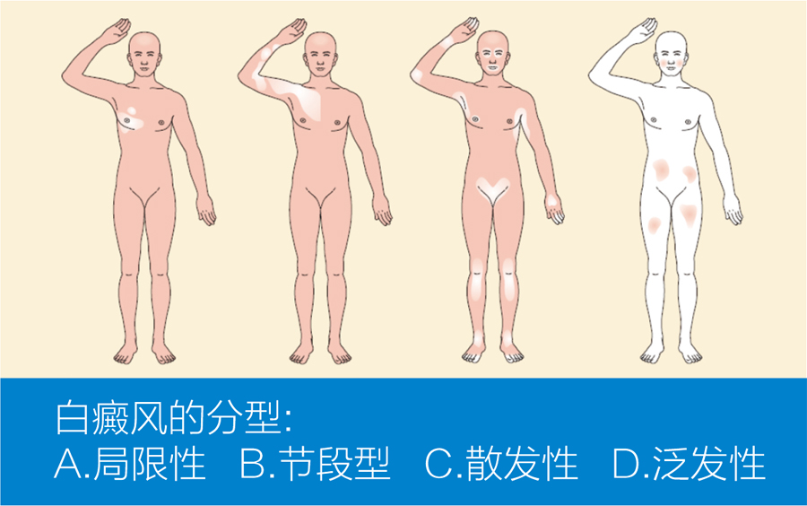 王宏偉教授專(zhuān)欄|白癜風(fēng)相關(guān)知識(shí)科普(圖2)